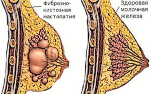 Фиброзно-кистозная мастопатия: симптомы, лечение, чем опасна, причины и диагностика