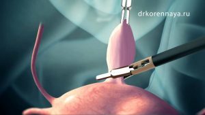Удаление миомы матки: размеры для операции, методы и последствия