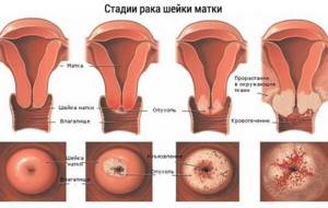 Рак шейки матки 1 стадии: сколько живут, прогноз выздоровления, лечение и симптомы