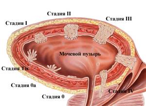 Опухоль мочевого пузыря: виды, симптомы, лечение, удаление у мужчин и женщин