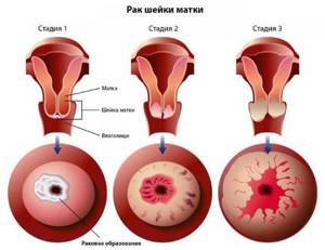 Рак шейки матки 2 стадии: лечение, прогноз продолжительности жизни, симптомы