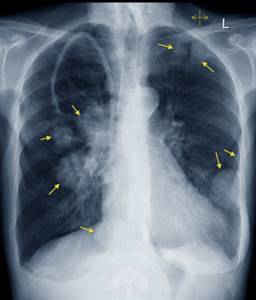Метастазы в лёгких: прогноз срока жизни, симптомы и лечение