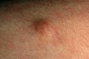Фиброма кожи: лечение, фото, симптомы, чем опасна