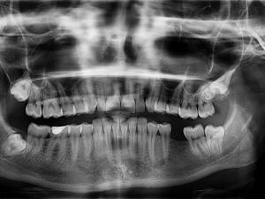 Остеома нижней челюсти: симптомы, лечение, фото и удаление