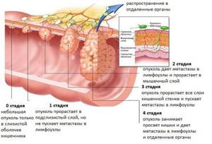 Аденокарцинома желудка: формы, прогноз, стадии, симптомы и лечение