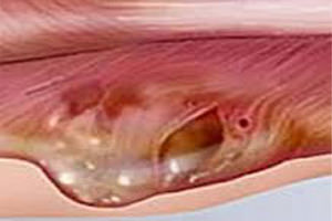 Саркома мягких тканей: фото начальной стадии, симптомы, прогноз и лечение