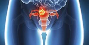 Рак шейки матки 3 стадии: сколько живут после операции, прогноз продолжительности жизни и выздоровления