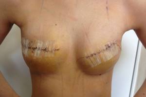 Удаление молочной железы при раке: операция, послеоперационный период и последствия