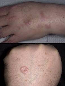Саркоидоз кожи: фото, симптомы, лечение и диагностика