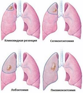 Аденокарцинома лёгкого: стадии, прогноз, симптомы и лечение