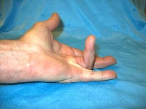 Онемение пальцев рук и ног после химиотерапии: что делать, лечение