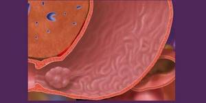 Тубулярная аденома толстой кишки: виды, симптомы и лечение