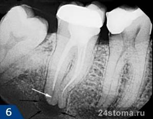 Гранулёма зуба: лечение, симптомы, фото, опасность, причины и снятие боли