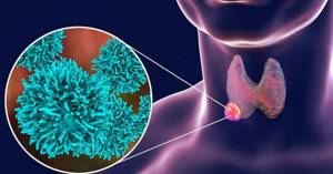 Папиллярный рак щитовидной железы: прогноз после операции, стадии и лечение