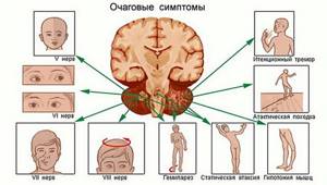 Опухоль мозжечка: симптомы, операция по удалению, прогноз и последствия