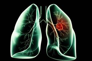 Лимфоузлы в лёгких: причины увеличения, расположение и лечение воспаления