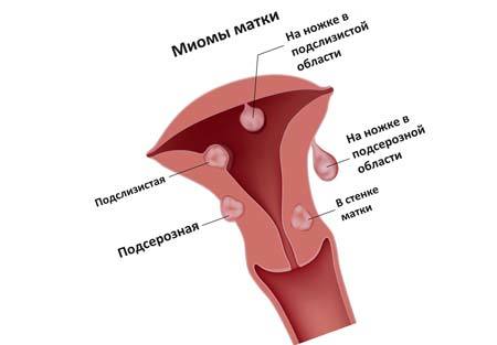 Миома матки в сочетании с эндометриозом: лечение и симптомы