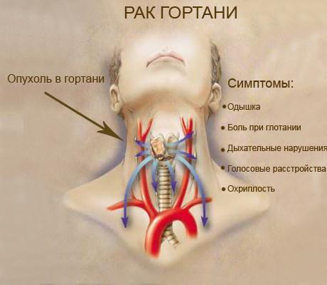 Опухоль гортани: симптомы, проявления, фото и лечение