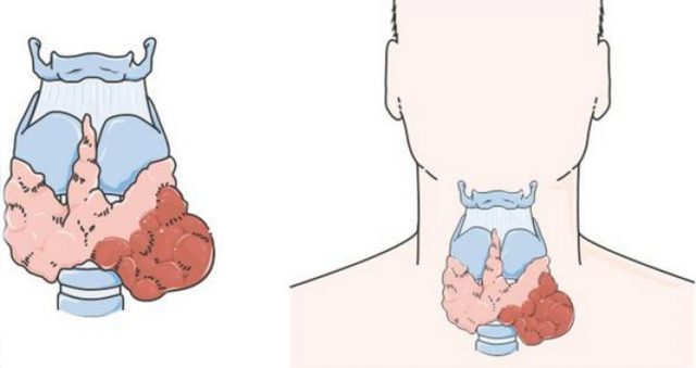 Фолликулярная аденома щитовидной железы: симптомы, лечение и операция