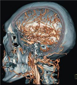 Ангиография сосудов головного мозга: как проводится, с контрастом и без, что показывает