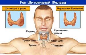 Рак паращитовидной железы: симптомы, прогноз жизни, диагностика и метастазы