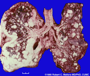 Саркома лёгких: симптомы, признаки, лечение и прогноз