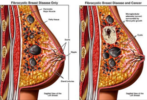 Фиброзно-кистозная мастопатия: симптомы, лечение, чем опасна, причины и диагностика