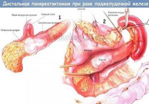 Опухоль поджелудочной железы: симптомы, лечение, прогноз и операция по удалению