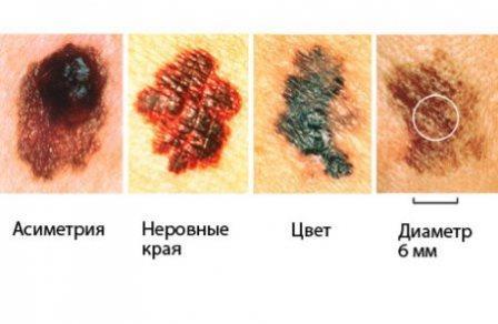 Узловая меланома: фото начальной стадии и прогноз